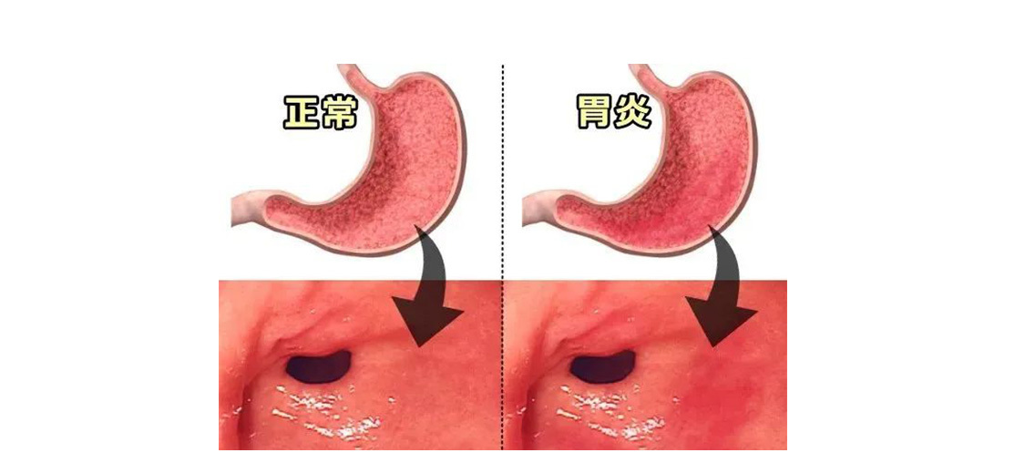 胃炎別大意，4步發展到癌