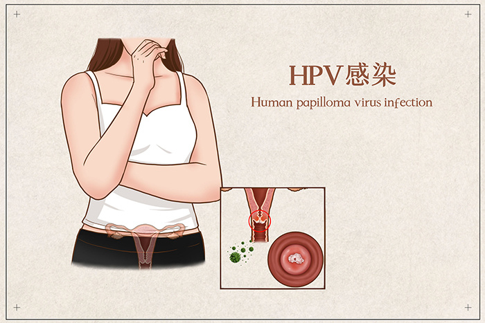 菌群發(fā)展失衡 促進(jìn)人乳頭瘤病毒（HPV）持續(xù)感染及宮頸癌變