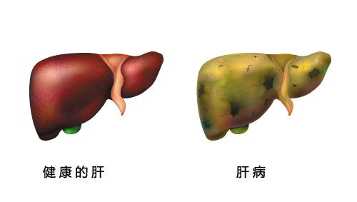 間充質干細胞治療肝硬化的潛力