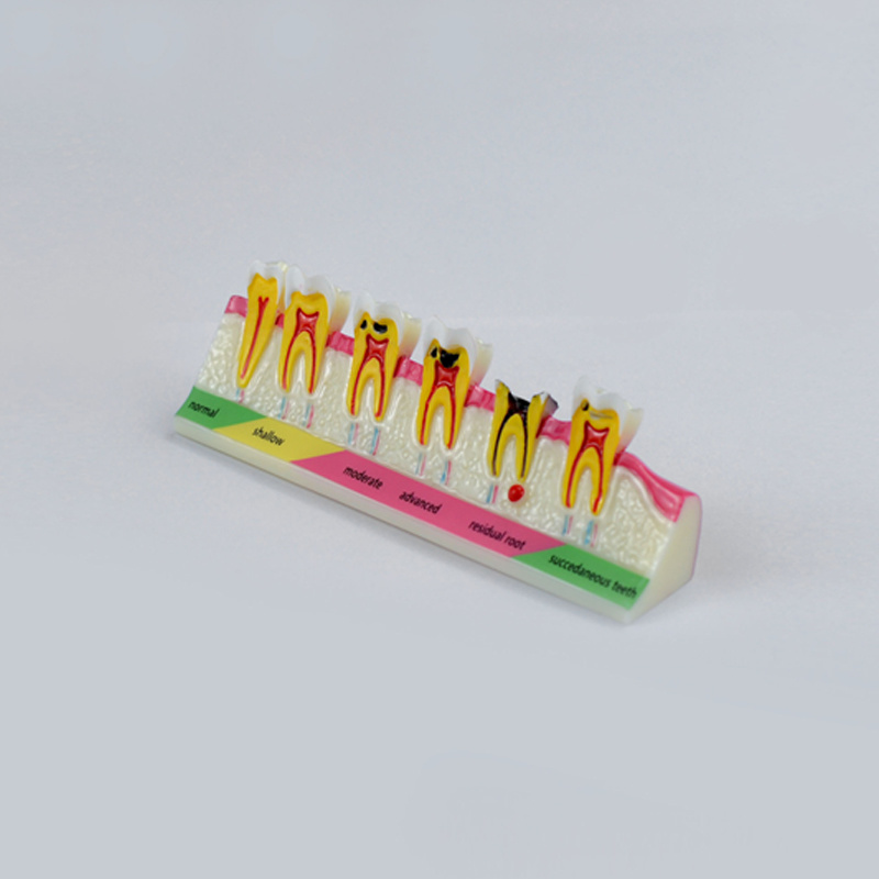 Root Canal Treatment Model