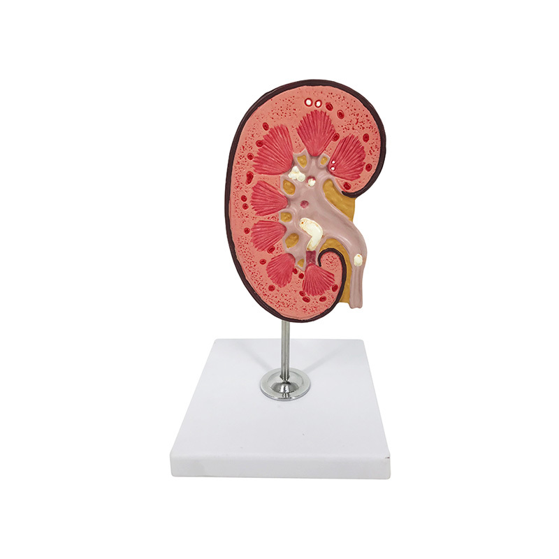 YA/U024 Kidney Stone Anatomy Model