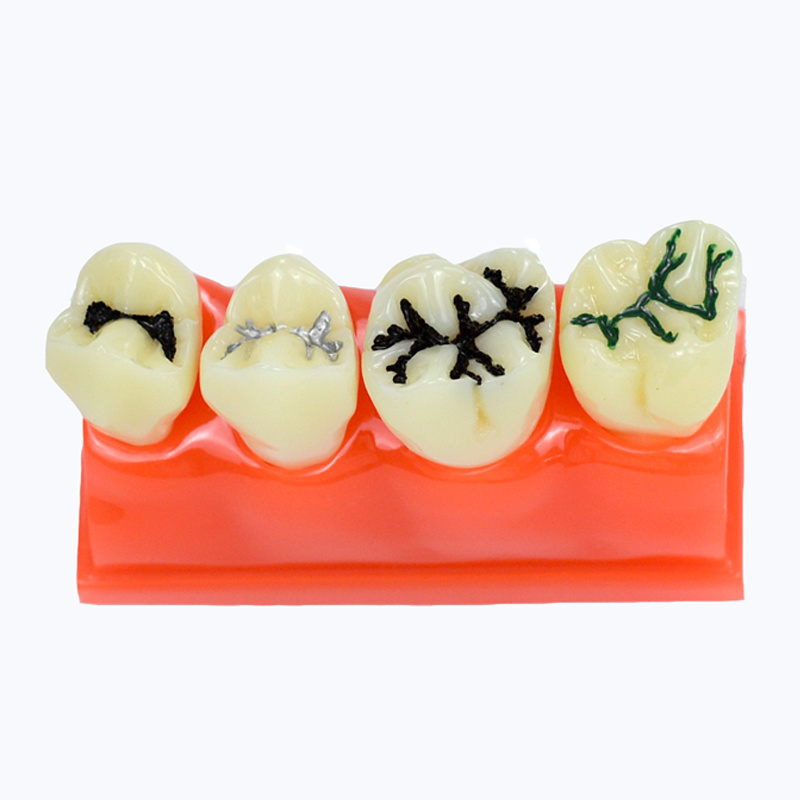 Pit and Fissure Sealant Model