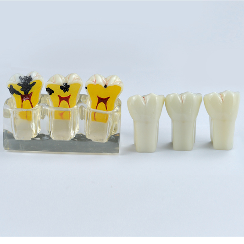 Dental Caries Demonstration Model