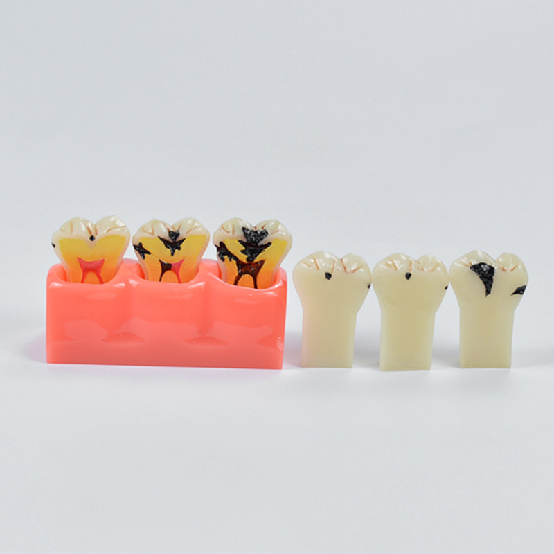 Dental Caries Demonstration Model