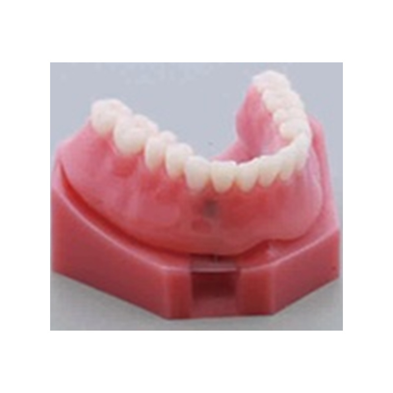 Implantn and Restoration Model