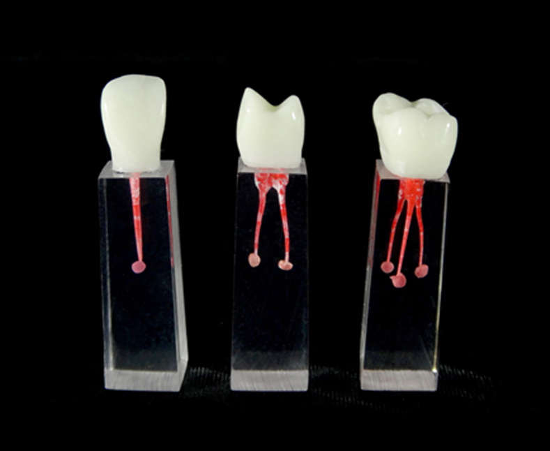 Filling and Widening of the Root Canal with Coronal Cyst