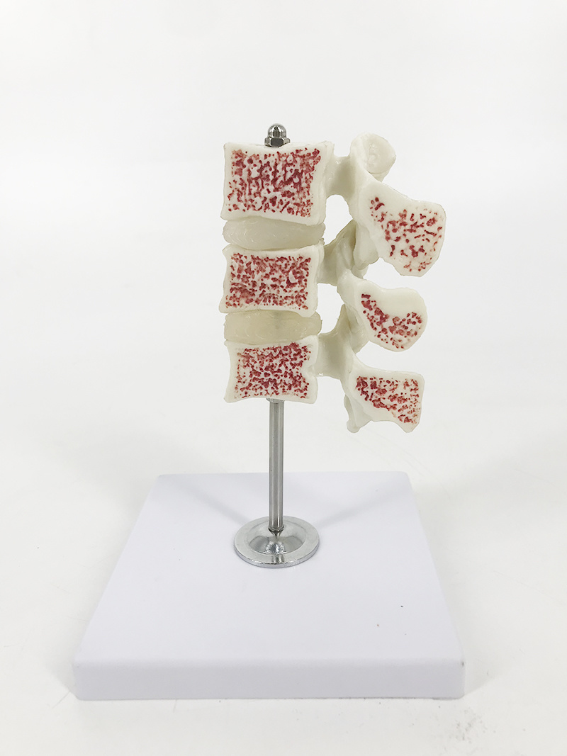 YA/L034 Deluxe Osteoporosis Anatomy Model