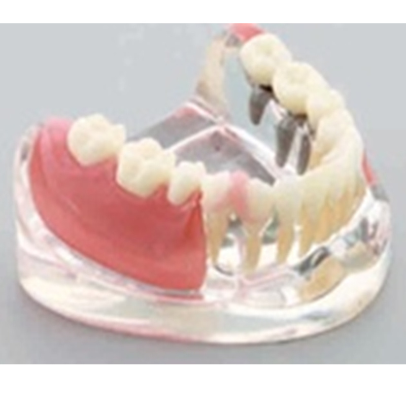 Comparison Model of Implantn and Restoration