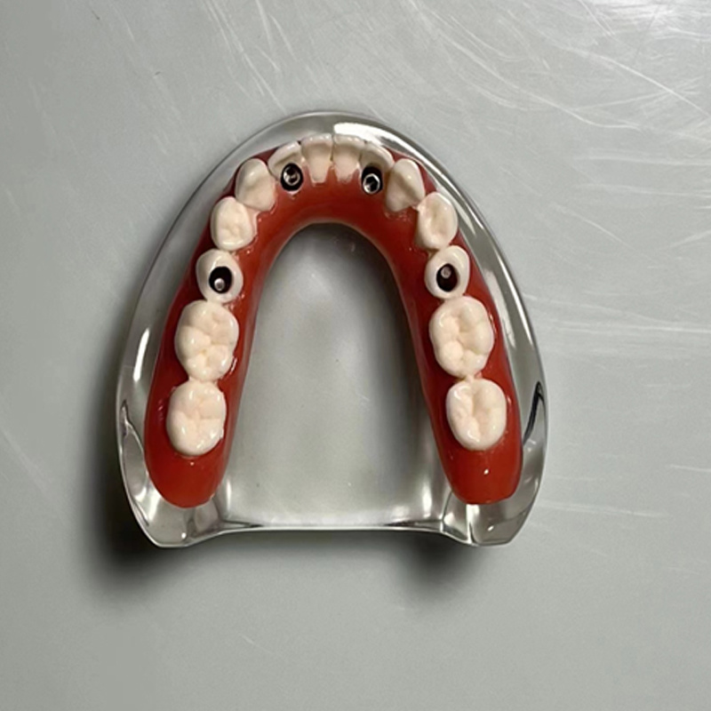 Mandibular Denture Implant Repair Model - Four Implants