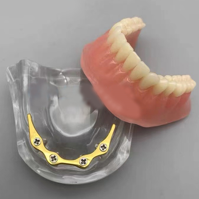 Implantn and Restoration Model with Golden Rod