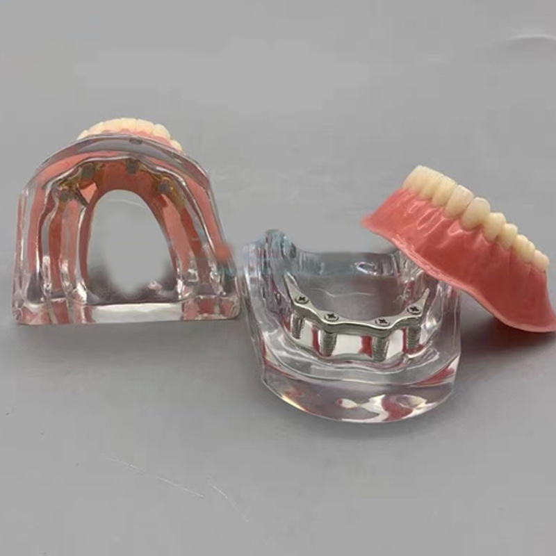 Implantn and Restoration Model with Silver Rod