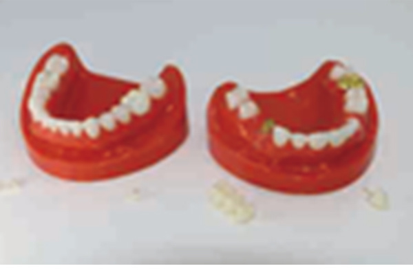 Dental Restoration Model