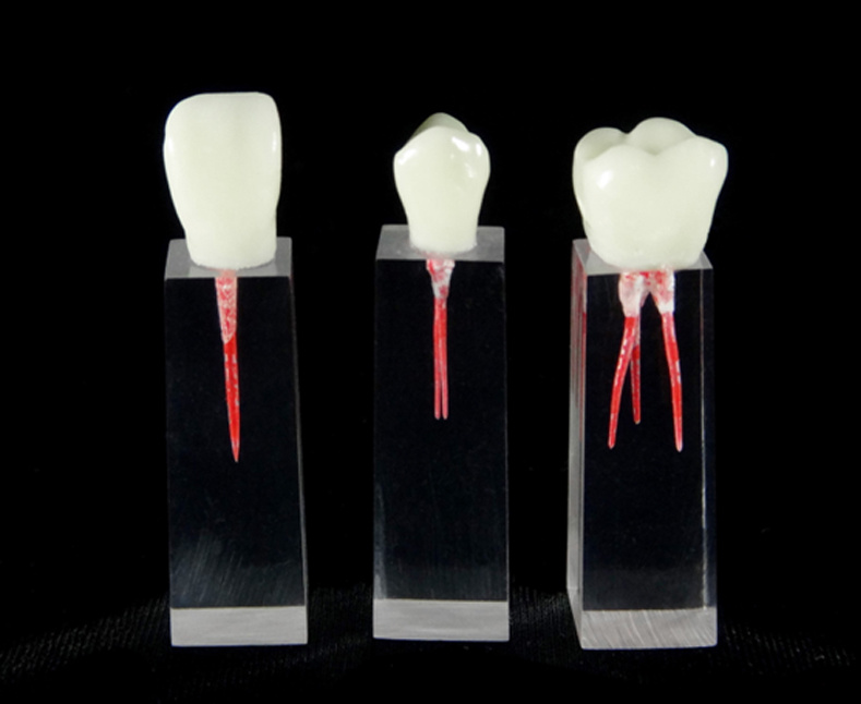 Filling and Widening of the Root Canal with Crown