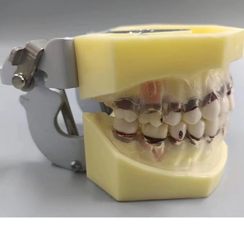 Periodontosis Model with Transparent Gingiva