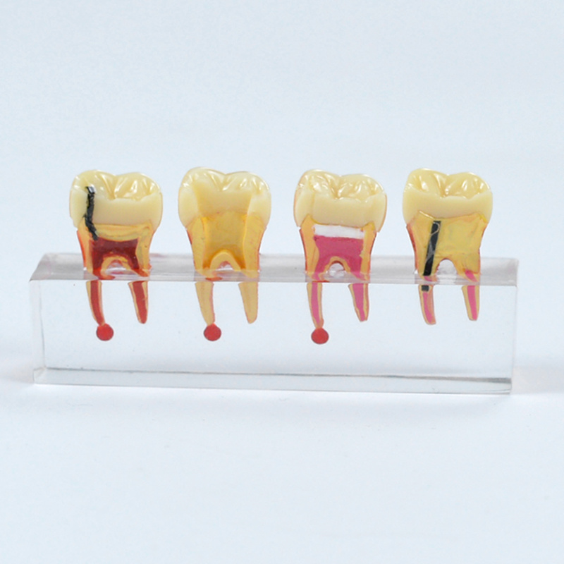 Dental Pulp Disease Treatment Model