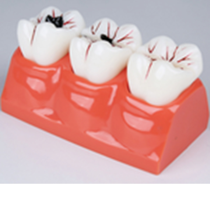 Dental Caries Demonstration Model