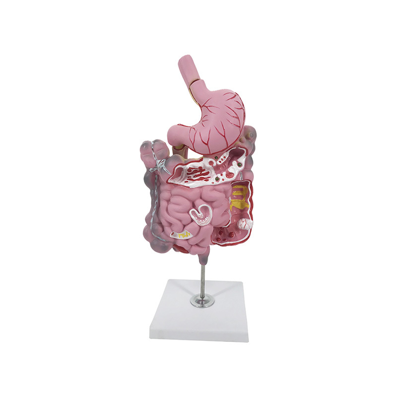 YA/D013 Diseased Digestive System Model