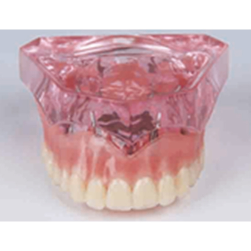 Dental Restoration Model