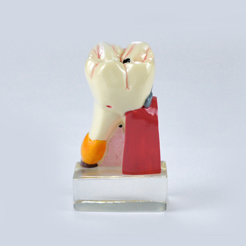 4X Comprehensive Dental Disease Model