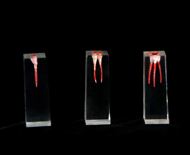 Filling and Widening of the Root Canal