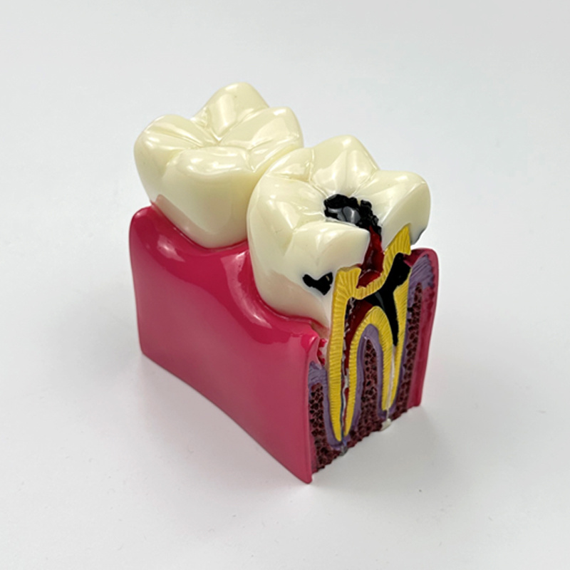 Dental Caries Demonstration Model