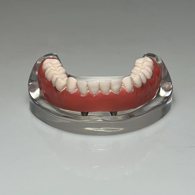 Dental Restoration Model