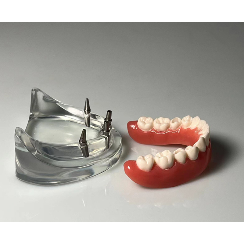 Dental Restoration Model