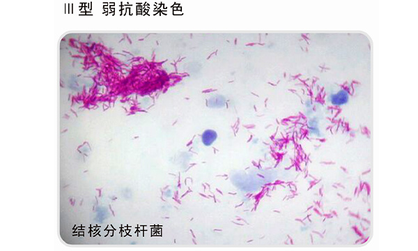 抗酸染色液(Ⅲ型）