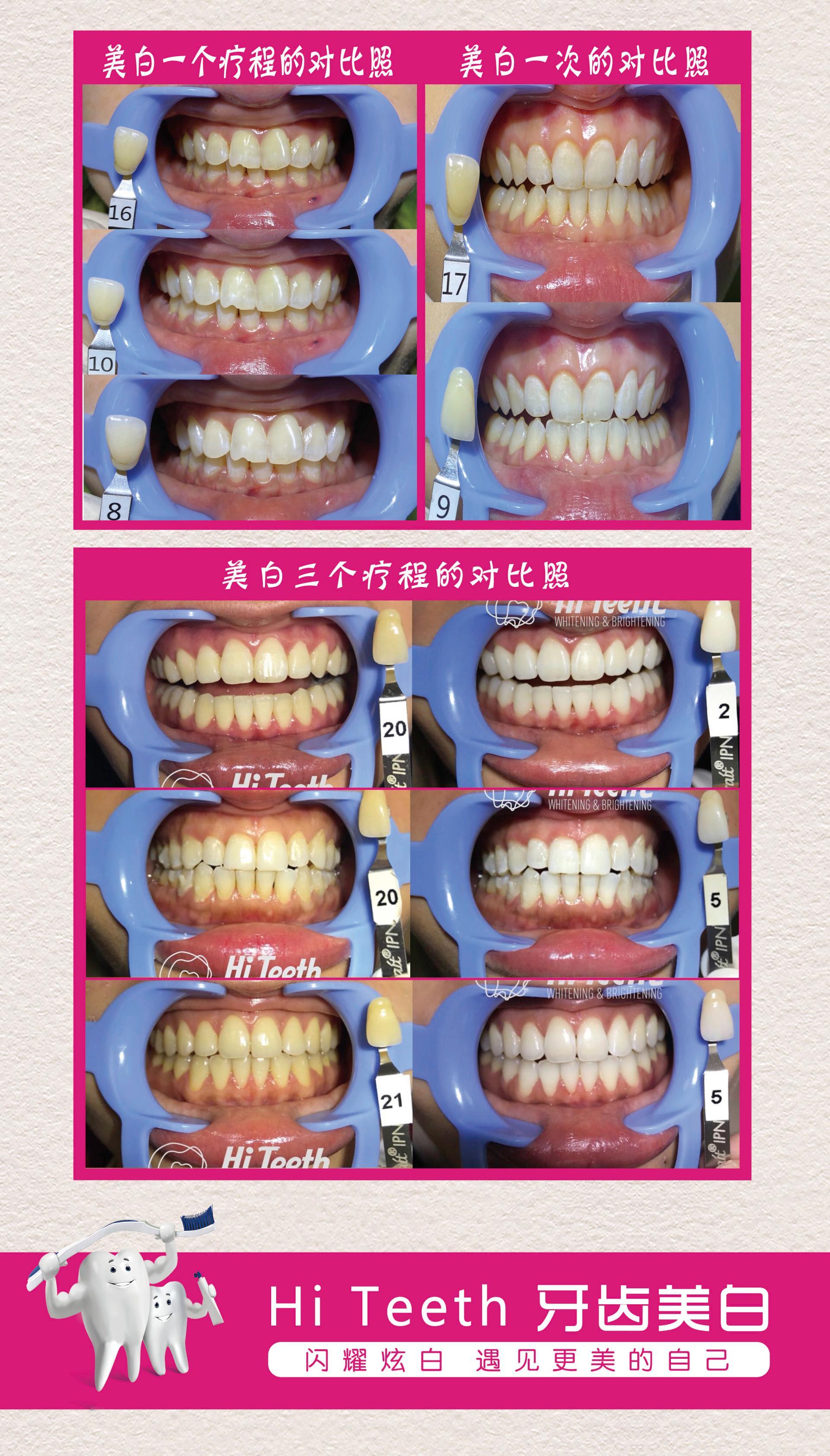牙齒美白