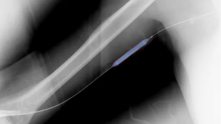 What is the balloon angioplasty procedure?