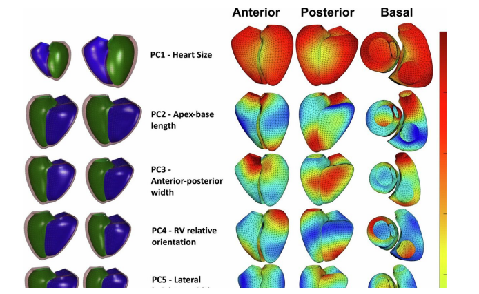 Study: Genetic Information Related to Heart Shape Can Provide Risk Score for Heart Disease