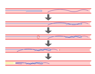 Update on the Diagnosis and Treatment of Coronary Complications of Percutaneous Coronary Interventions