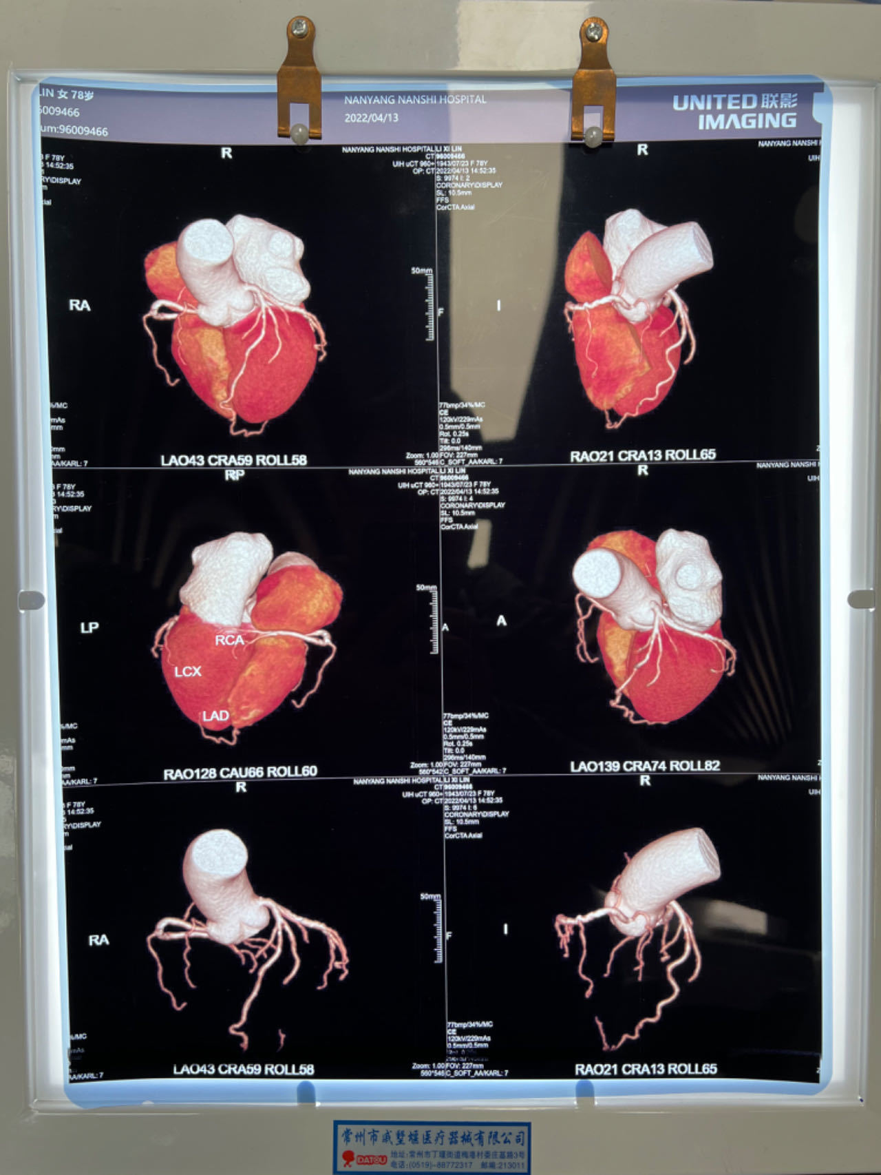 Inkjet Medical X Ray Film Blue Sheet