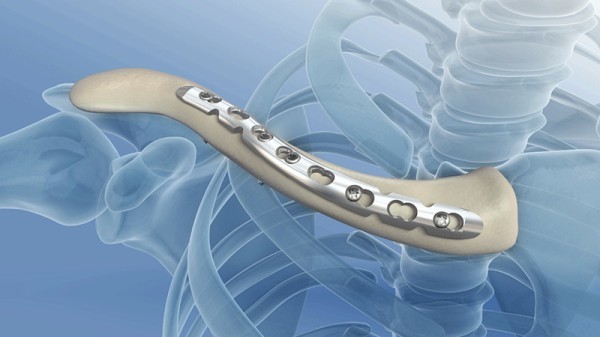 CNC machining supports the processing of advanced biomaterials