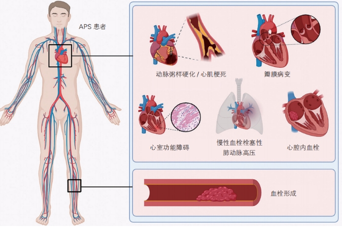 年輕人急性心梗相關，這一原因不容忽視