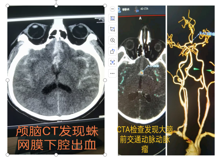 醫(yī)共體上下聯(lián)動  生死時速顯神威 孝感市中醫(yī)院成功救治大腦前動脈瘤破裂患者