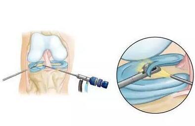 Arthroscopic technology: a new milestone in modern medicine