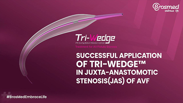 Case Interpretation| Application of Tri-Wedge™ in Juxta-anastomotic Stenosis(JAS) of AVF