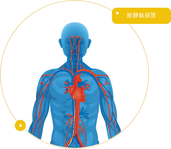 股静脉插管/ Femoral Venous Cannula