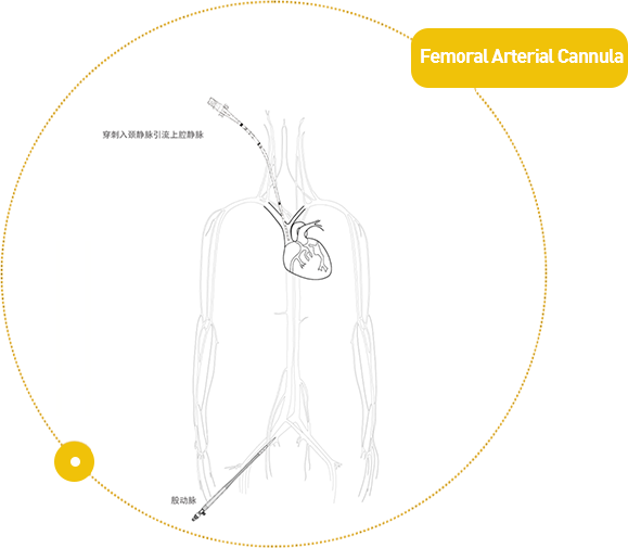 Femoral artery cannulation/Femoral Arterial Cannula