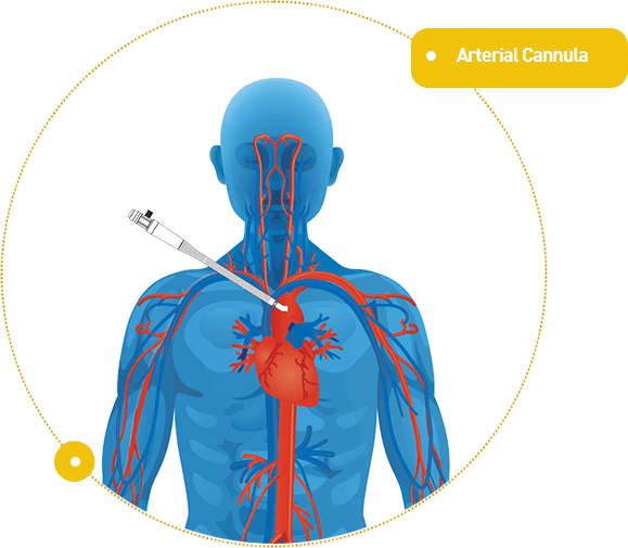 Arterial cannulation/Arterial Cannula