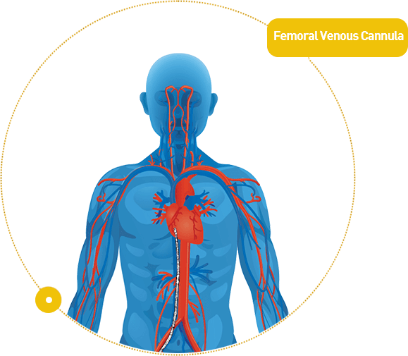 Femoral vein cannula/Femoral venous Cannula