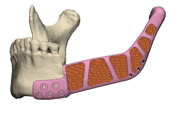 Maxillofacial bone defect customized prosthesis