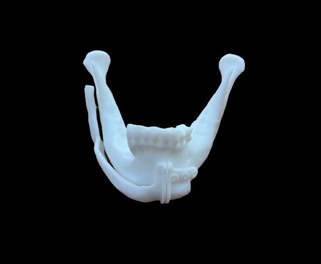 Maxillofacial tumor osteotomy guide plate