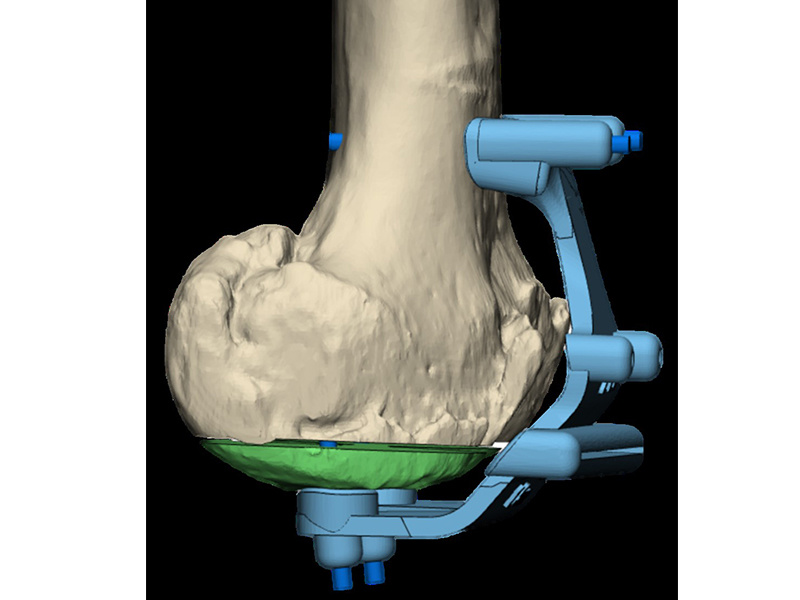 Femoral condyle replacement osteotomy guide plate