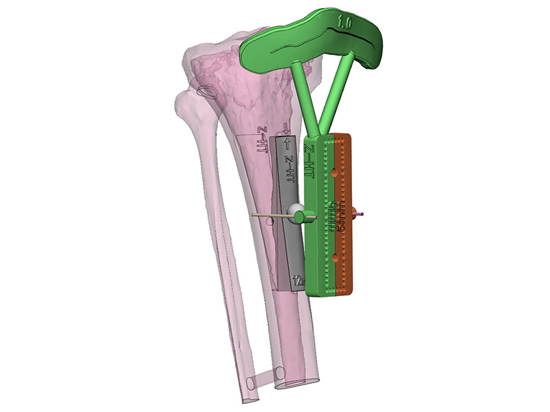 Diabetic foot bone Transverse bone handling Osteotomy guide plate