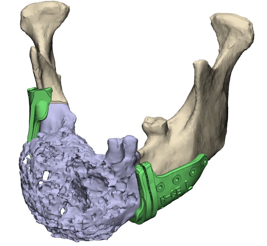 Maxillofacial tumor osteotomy guide plate