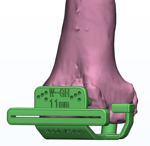 Femoral condyle replacement osteotomy guide plate