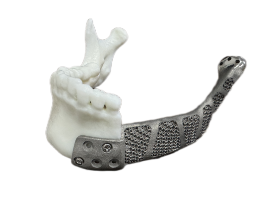 Maxillofacial bone defect customized prosthesis