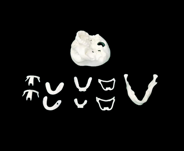 Subapical osteotomy guide plate